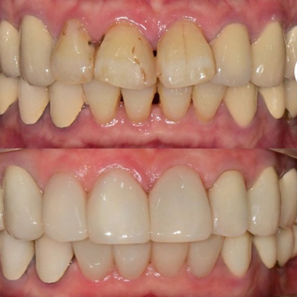 Vorher-nachher-Ergebnis Non-Prep-Veneers bei Yonsei Dagam Dental Office