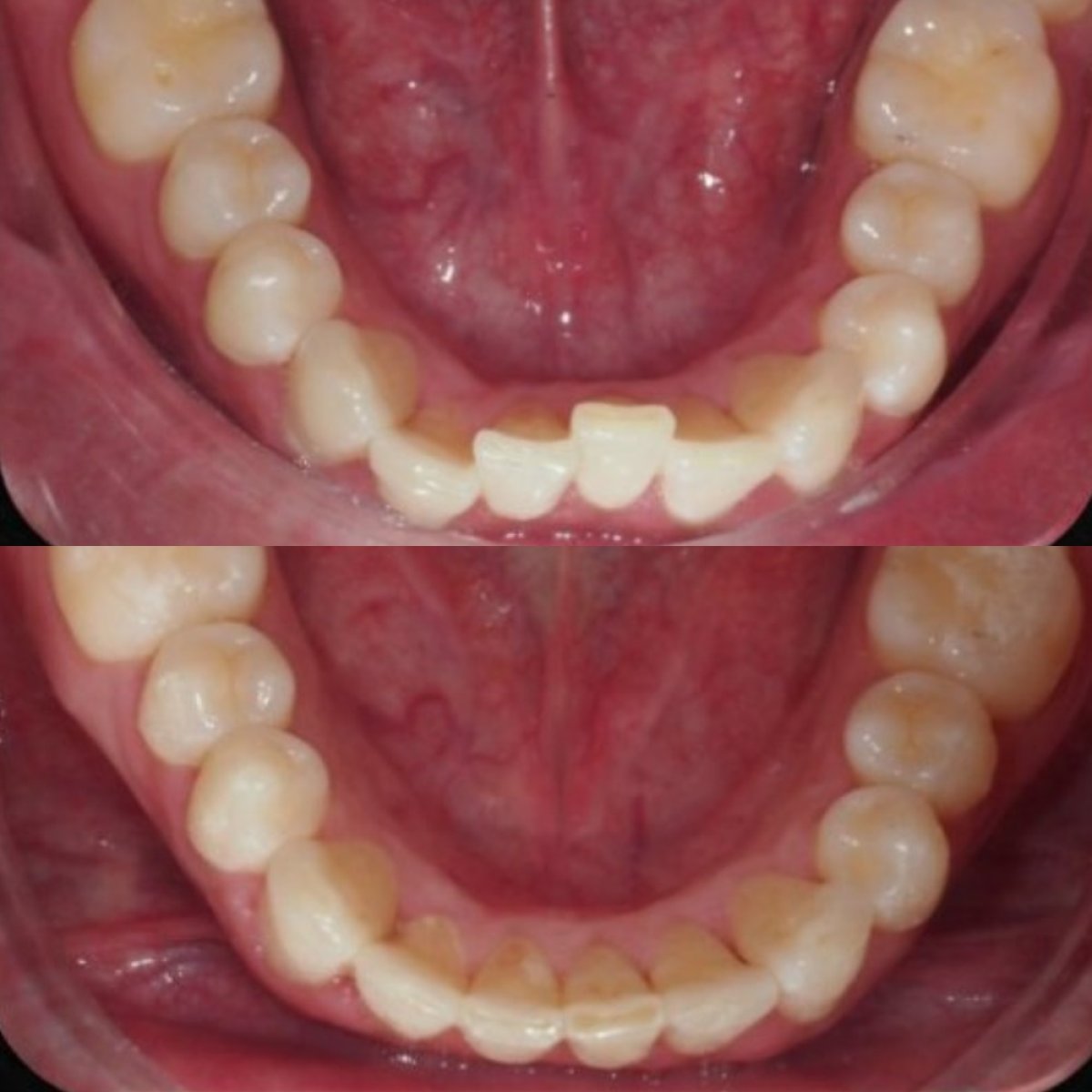 Resultados antes y después de brackets en GNUX Dental Cancun – alineación dental mejorada