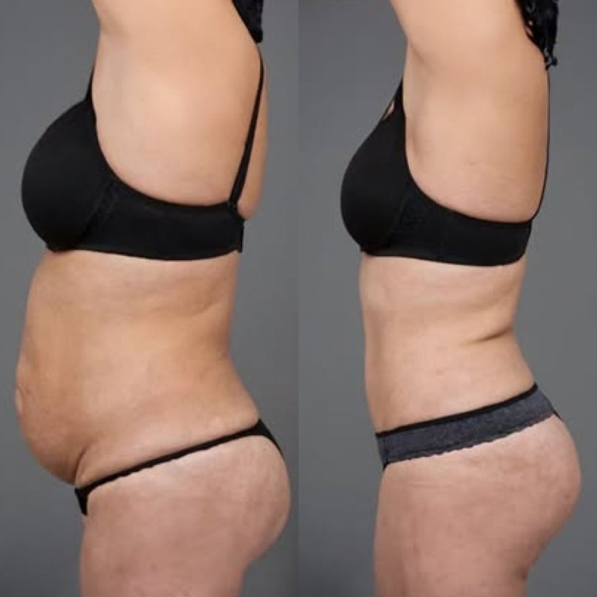 Vorher-nachher-Ergebnis der Vaser-Liposuktion bei Holiday Estetic, sichtbare Bauchkontur