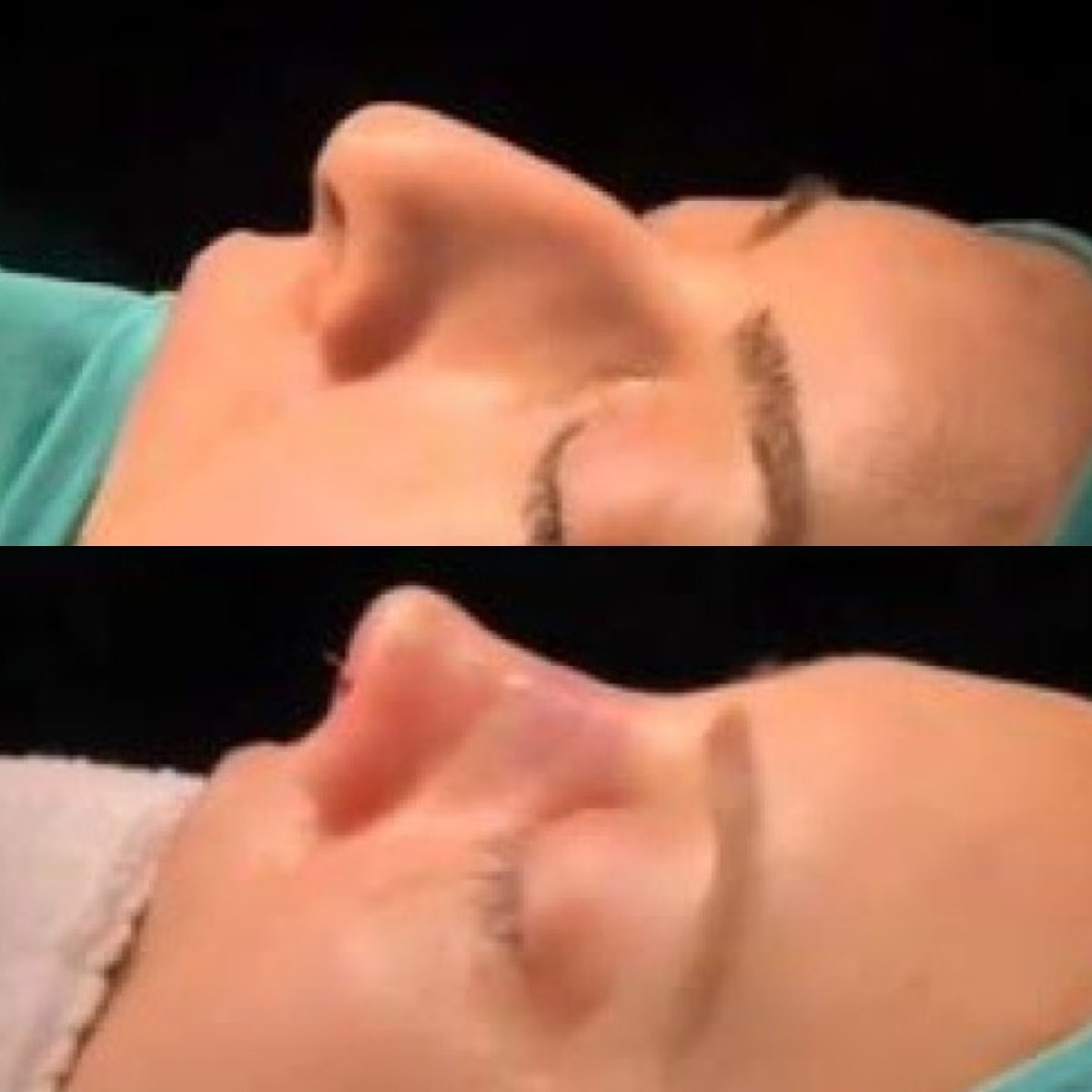 Before and after rhinoplasty results at Sona Health Clinic, nose reshaping and profile improvement