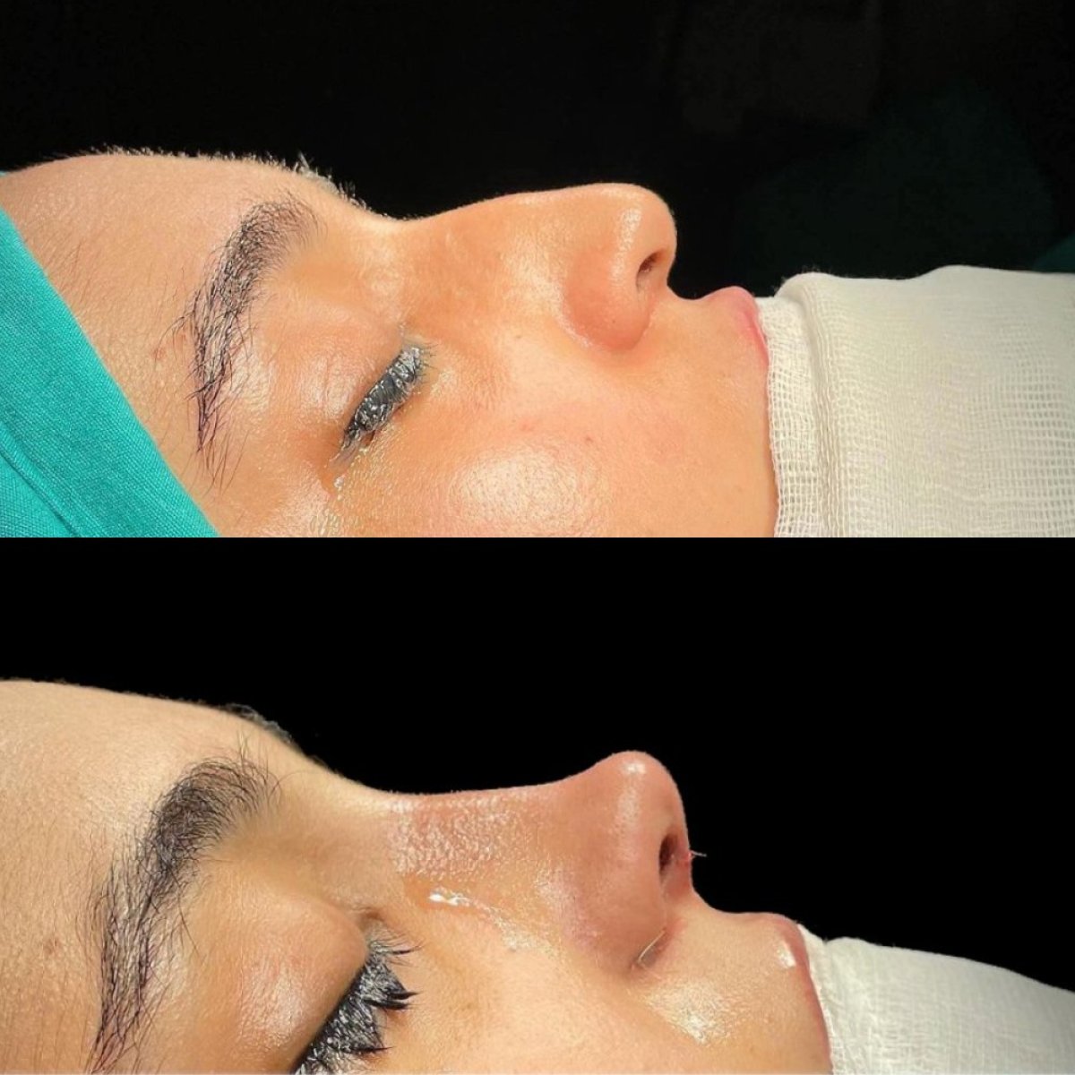 Before and after rhinoplasty results at Sona Health Clinic, nose reshaping for improved profile