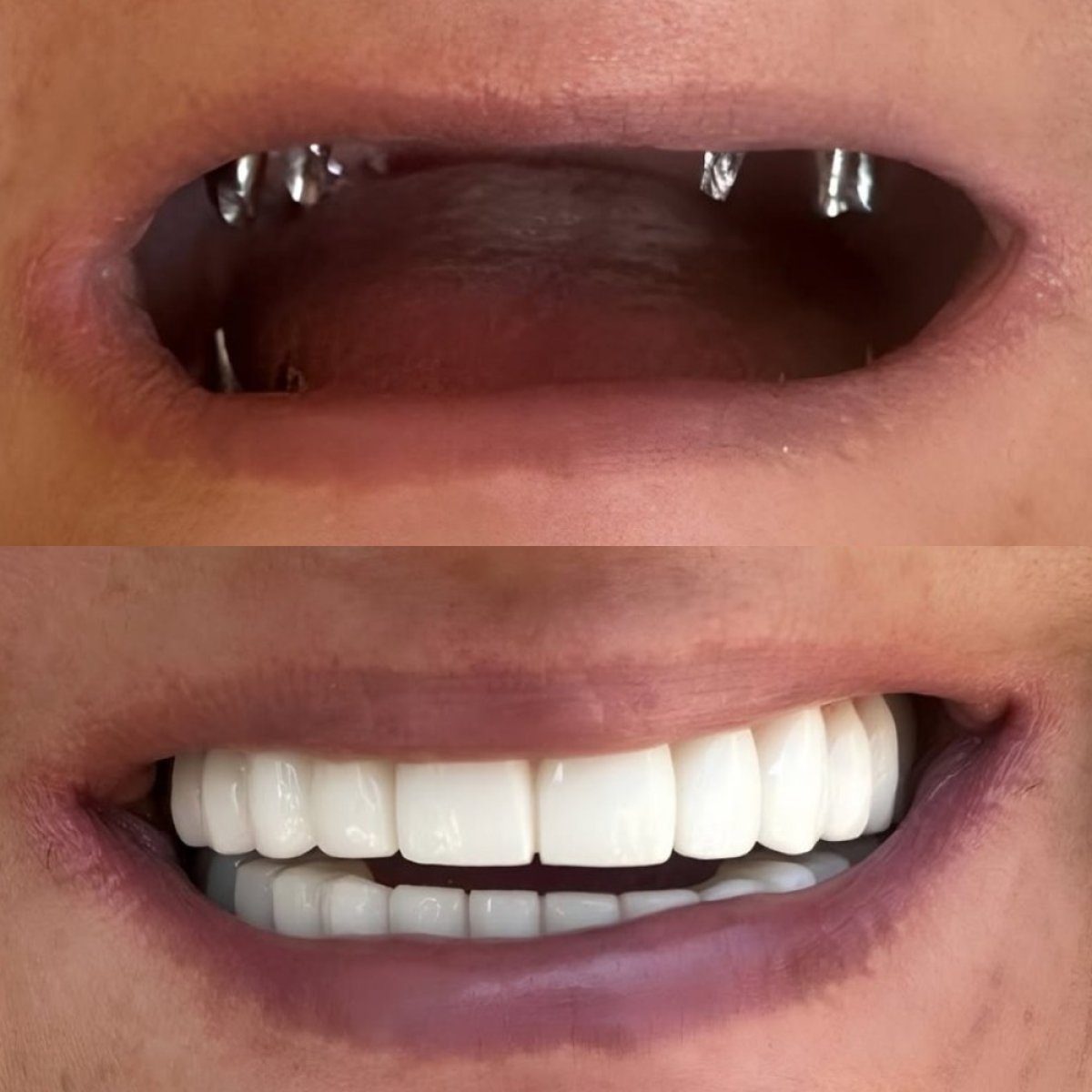 Before and after dental implant results at Özdemir Dental Center – restored full smile