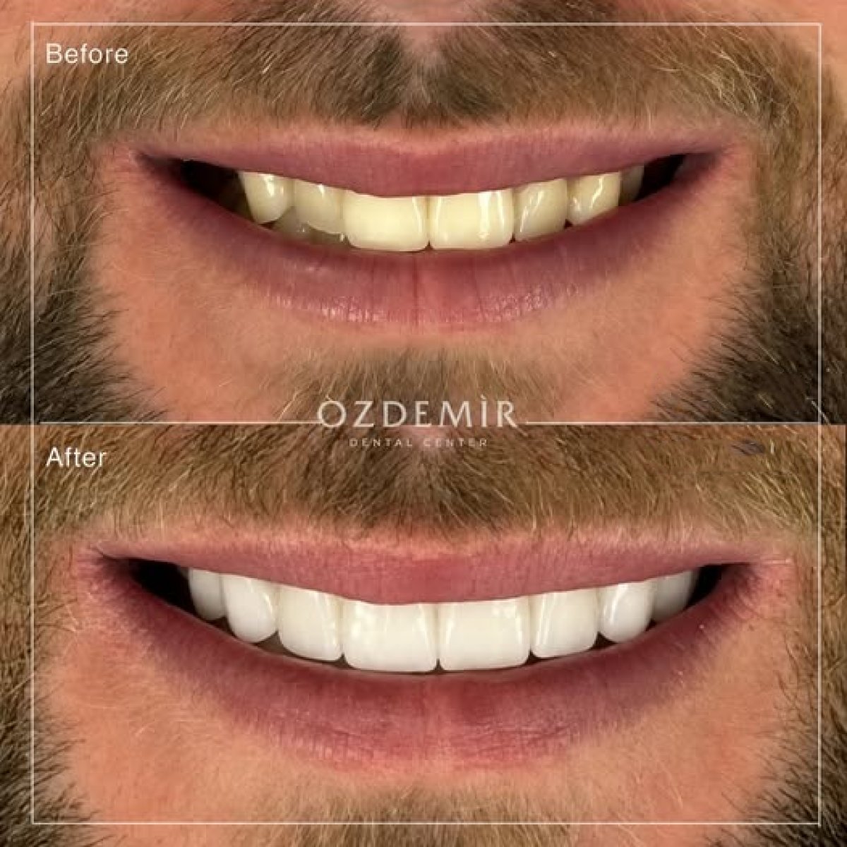 Before and after tooth whitening results at Özdemir Dental Center, visibly brighter smile
