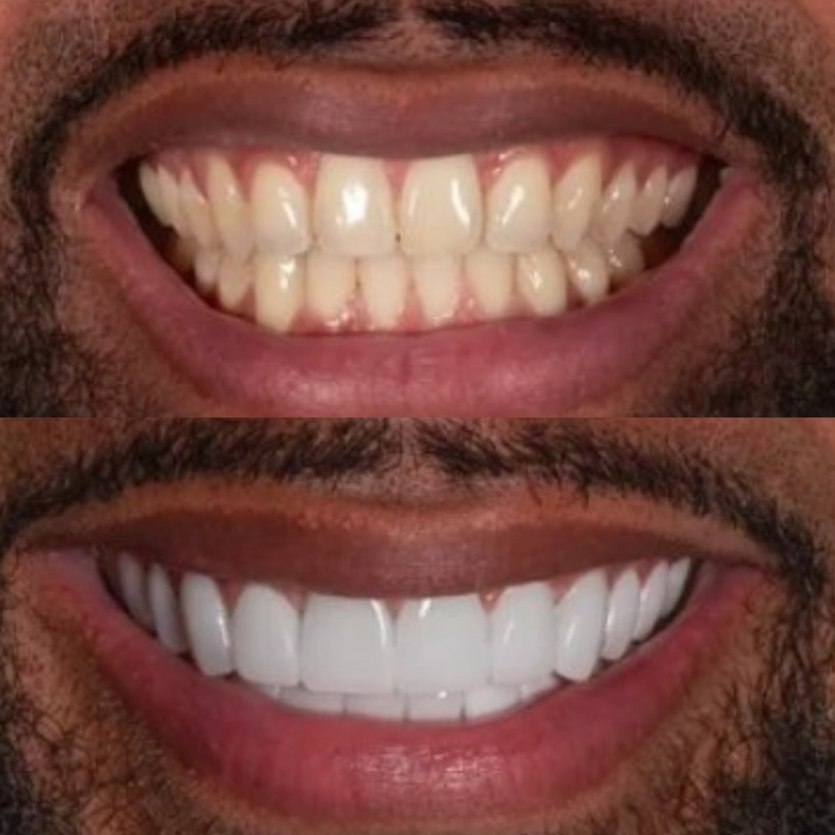Vorher-nachher-Ergebnis Veneers bei Darya Dental Turkey – verbesserte Ästhetik