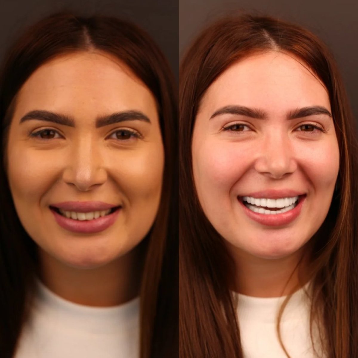 Vorher-nachher-Ergebnis Smile Makeover bei Darya Dental Turkey, sichtbare Zahnästhetik