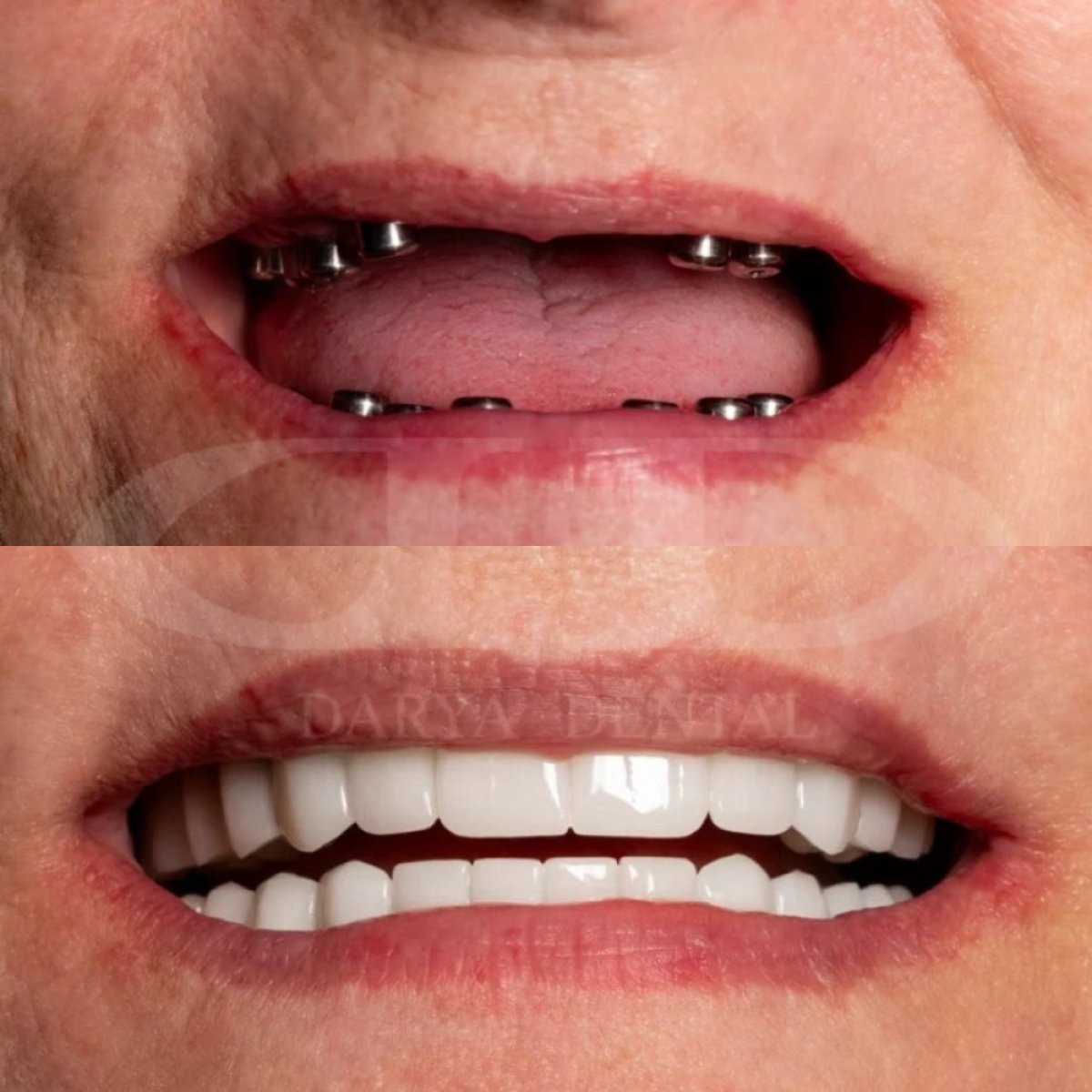 Before and after dental implant results at Darya Dental Turkey, restored smile transformation