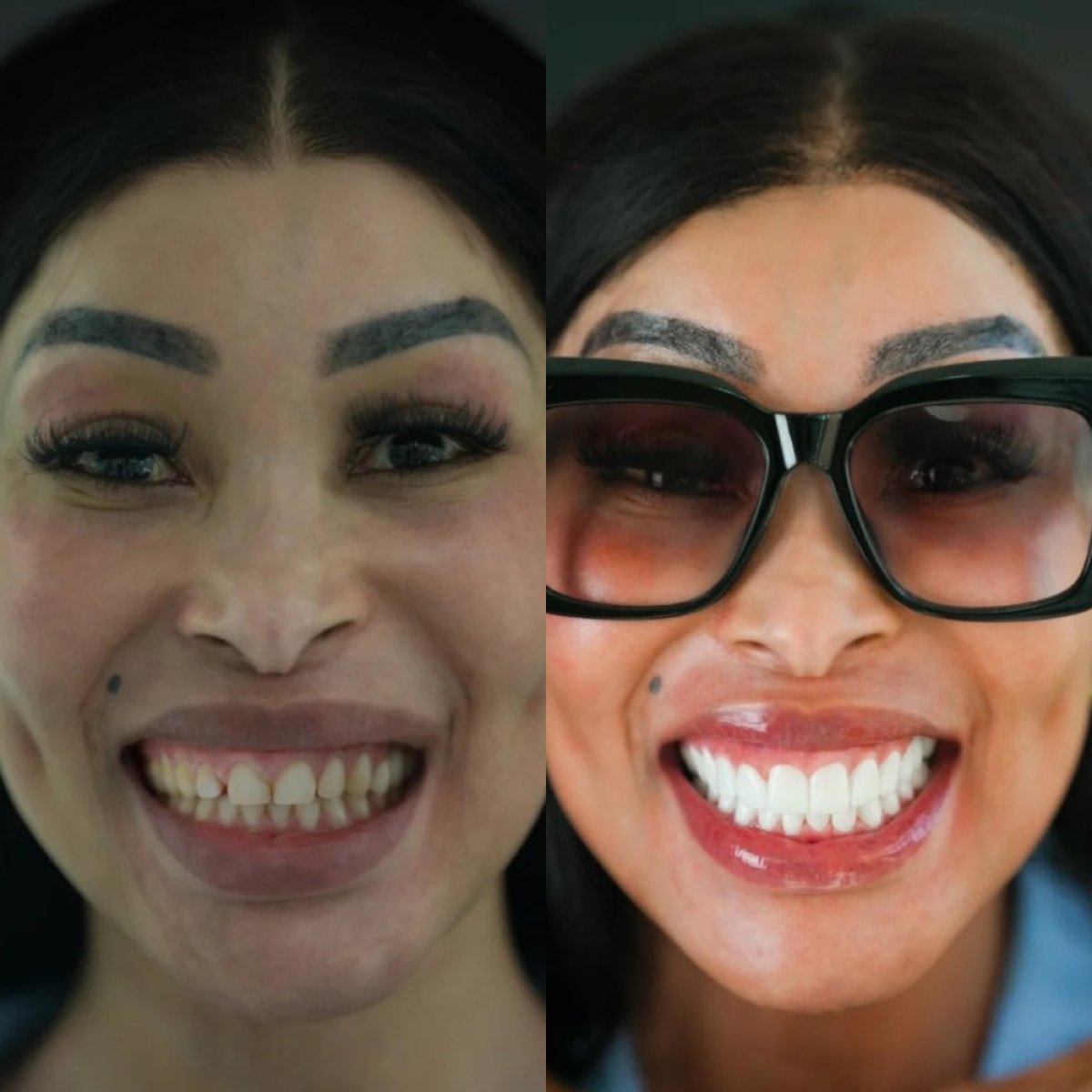Before and after zirconia crown results at Darya Dental Turkey, smile transformation visible