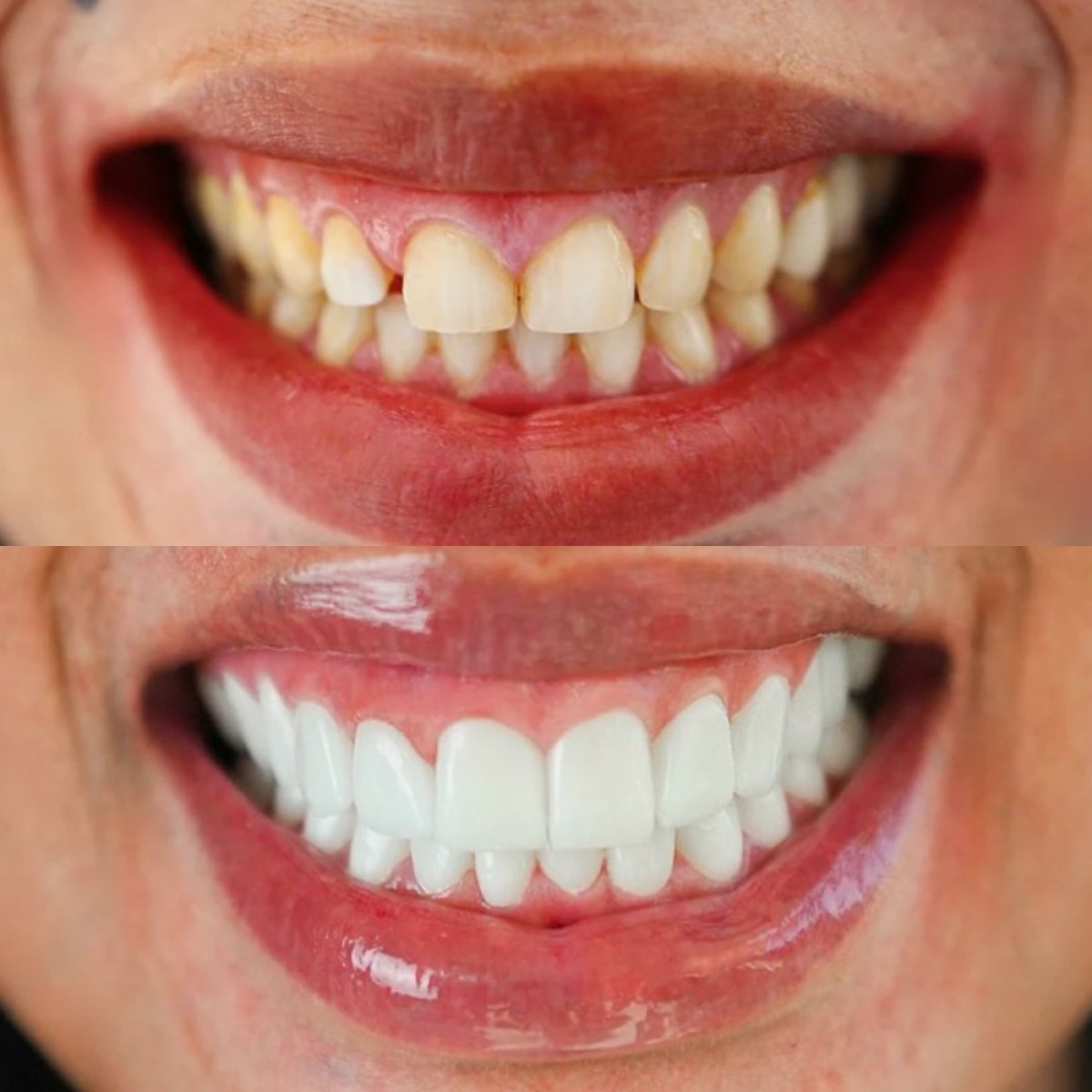 Résultats avant et après blanchiment dentaire au laser chez Darya Dental Turkey, sourire éclatant