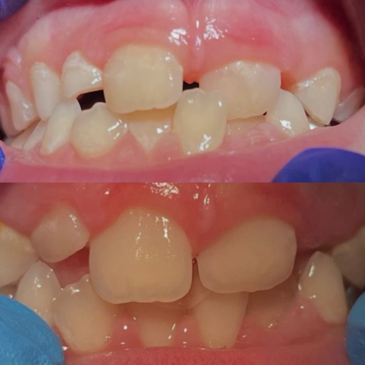 نتائج قبل وبعد تقويم الأسنان في KidsDent/Dr. Dt. Esra Yesiloz Gokcen، تحسين انتظام الأسنان