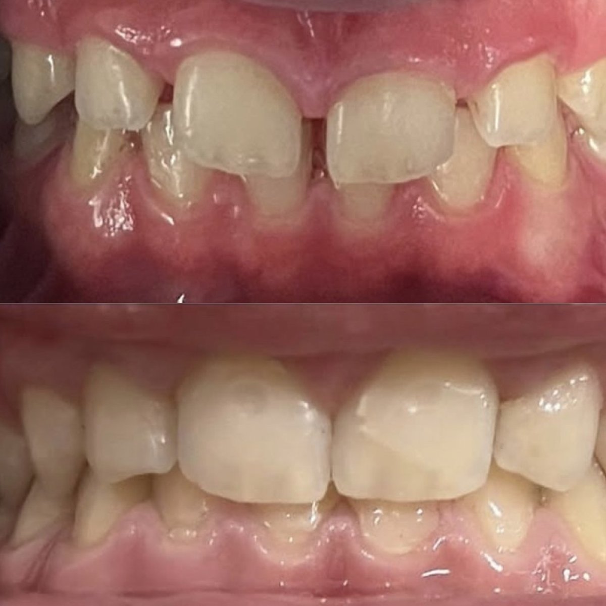 نتائج قبل وبعد التقويم في KidsDent/Dr. Dt. Esra Yesiloz Gokcen، تحسين انتظام الأسنان
