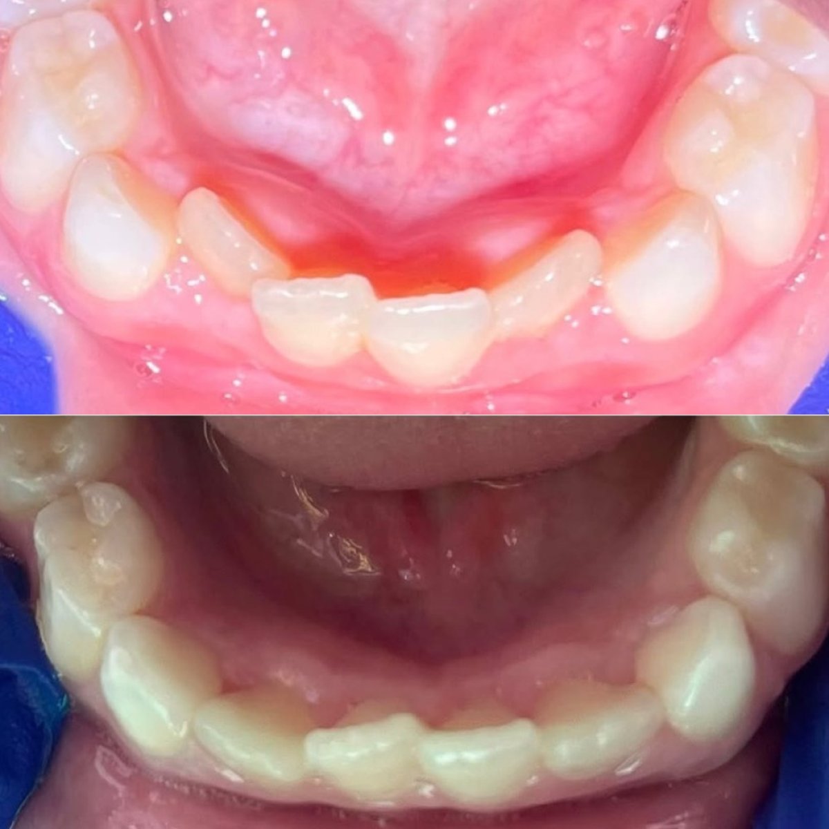 نتائج قبل وبعد تقويم Invisalign للأطفال في عيادة KidsDent/Dr. Dt. Esra Yesiloz Gokcen