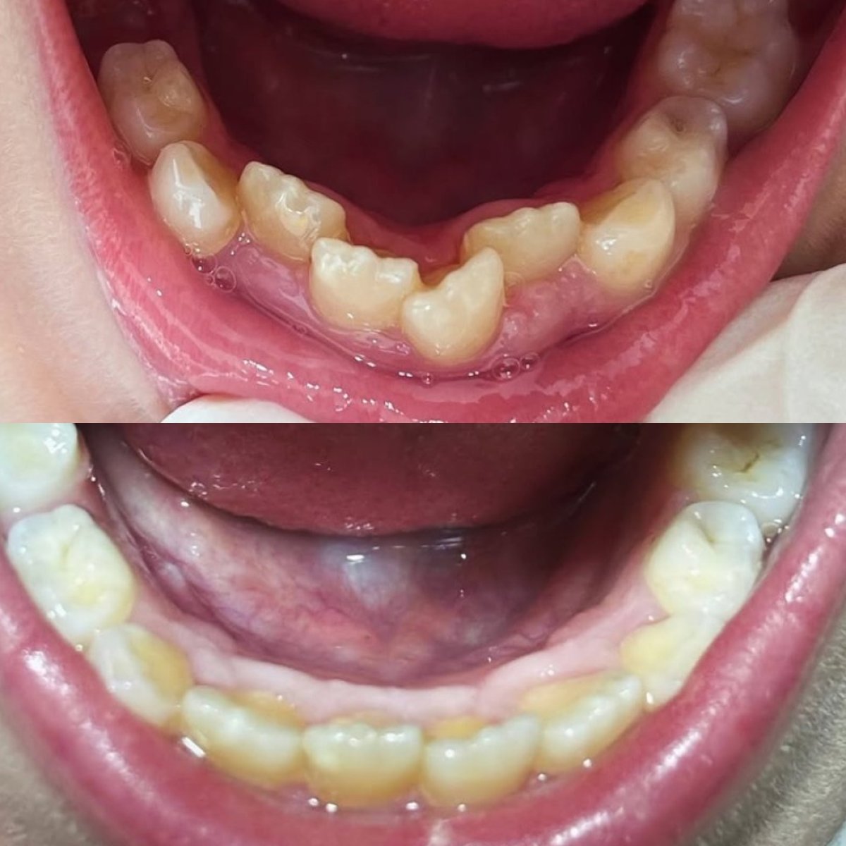 نتائج قبل وبعد التقويم الشفاف في KidsDent/Dr. Dt. Esra Yesiloz Gokcen، تقويم الأسنان