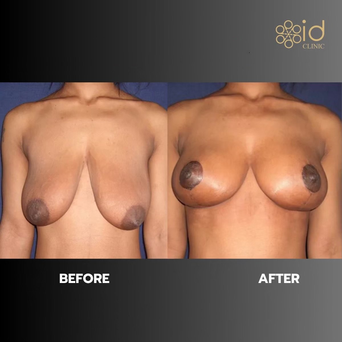 Before and after breast reduction results at ID Clinic Bangkok, improved breast shape and lift