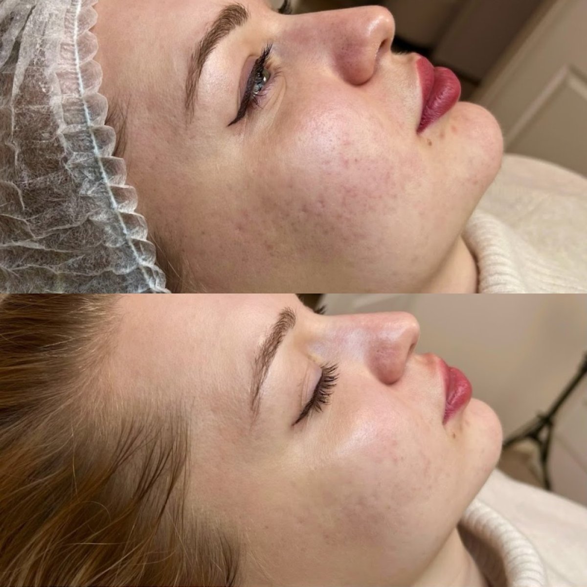 Before and after acne scar treatment at ARS Clinic – visible skin texture improvement result