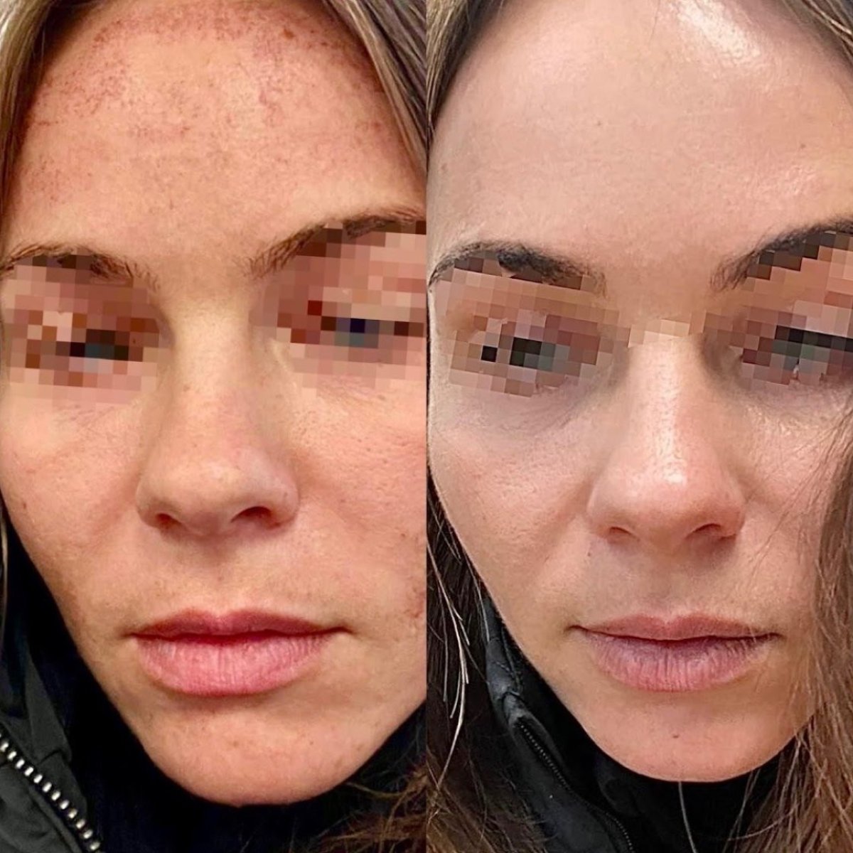 Before and after acne scar treatment at ARS Clinic, visible facial skin improvement result