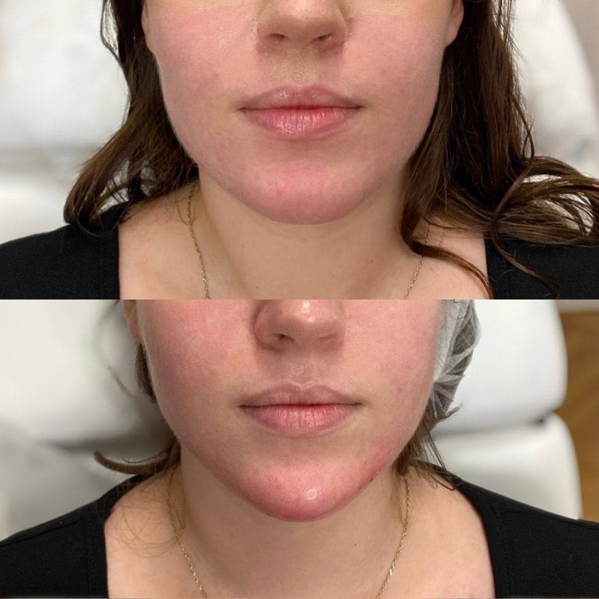 Before and after jaw shaping at ARS Clinic, enhanced chin contour and facial symmetry result