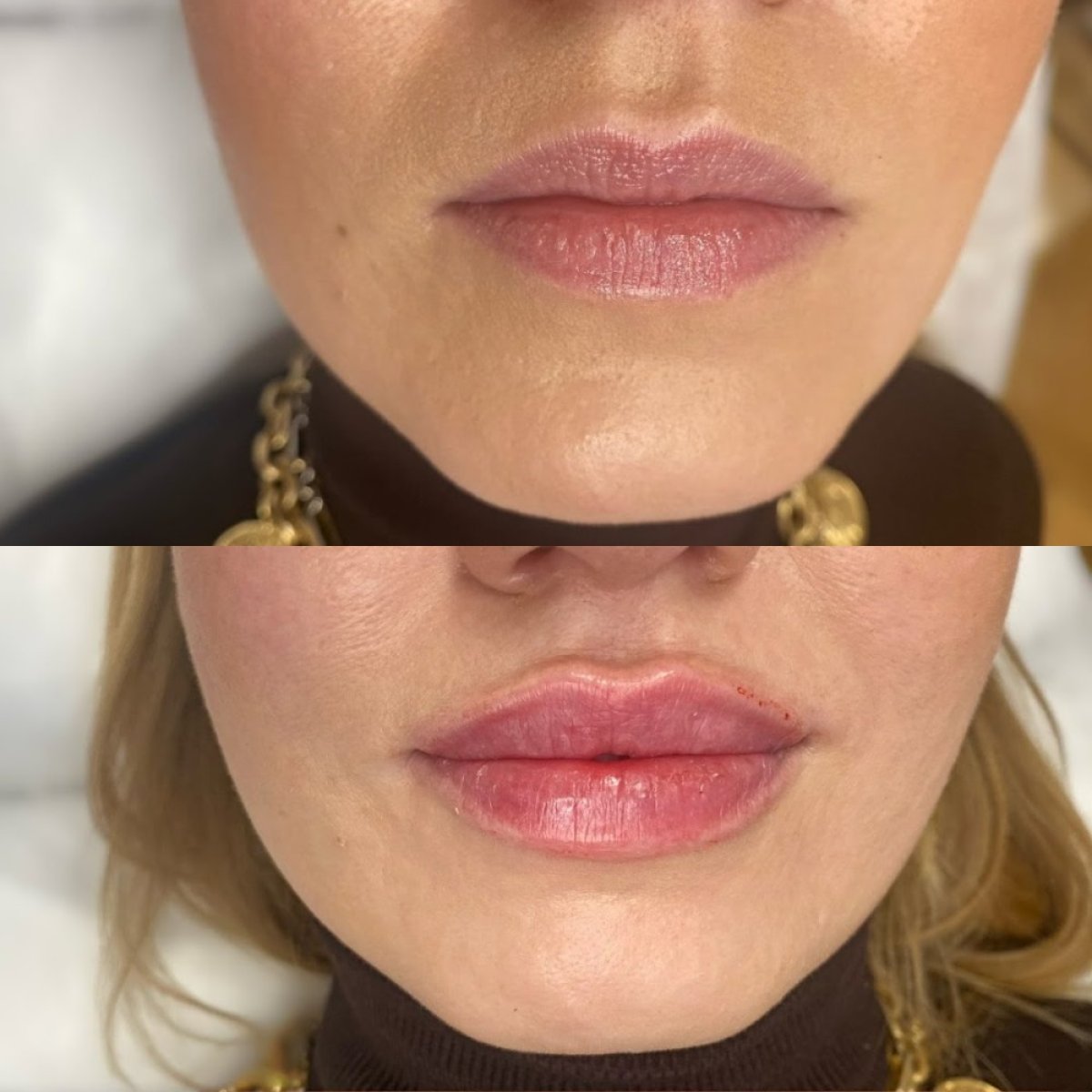 Before and after lip fillers injection at ARS Clinic, enhanced lip volume and contour result