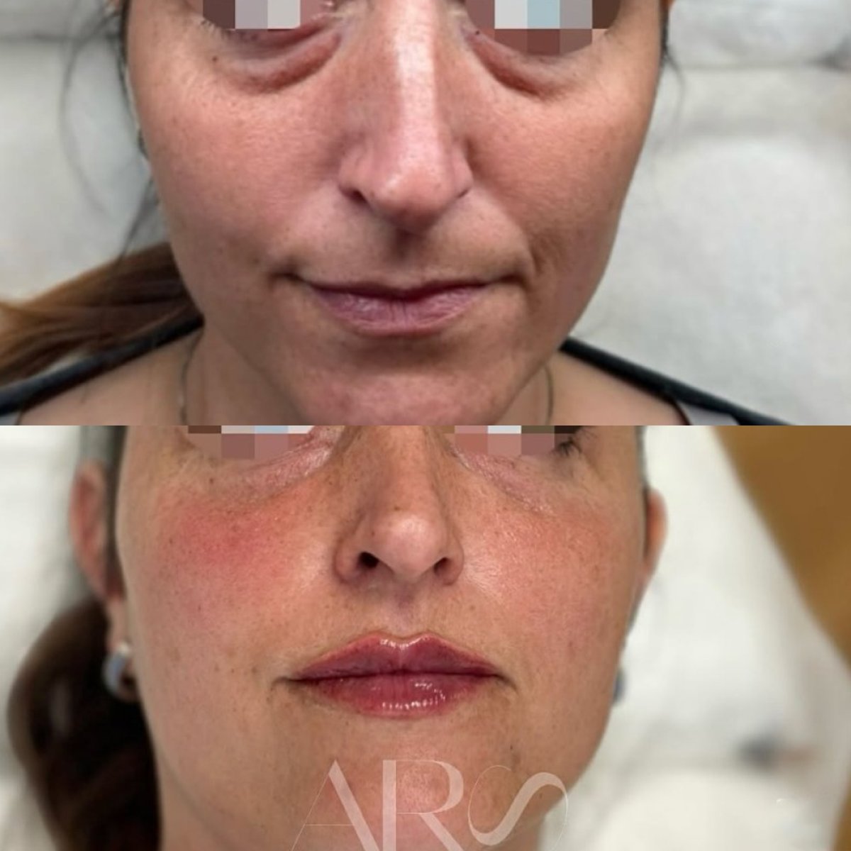 Before and after fillers injection at ARS Clinic, facial rejuvenation and enhanced lips result