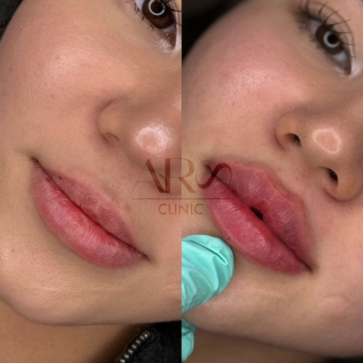 نتائج قبل وبعد حقن فيلر الشفاه في ARS Clinic، زيادة حجم وتحديد الشفاه