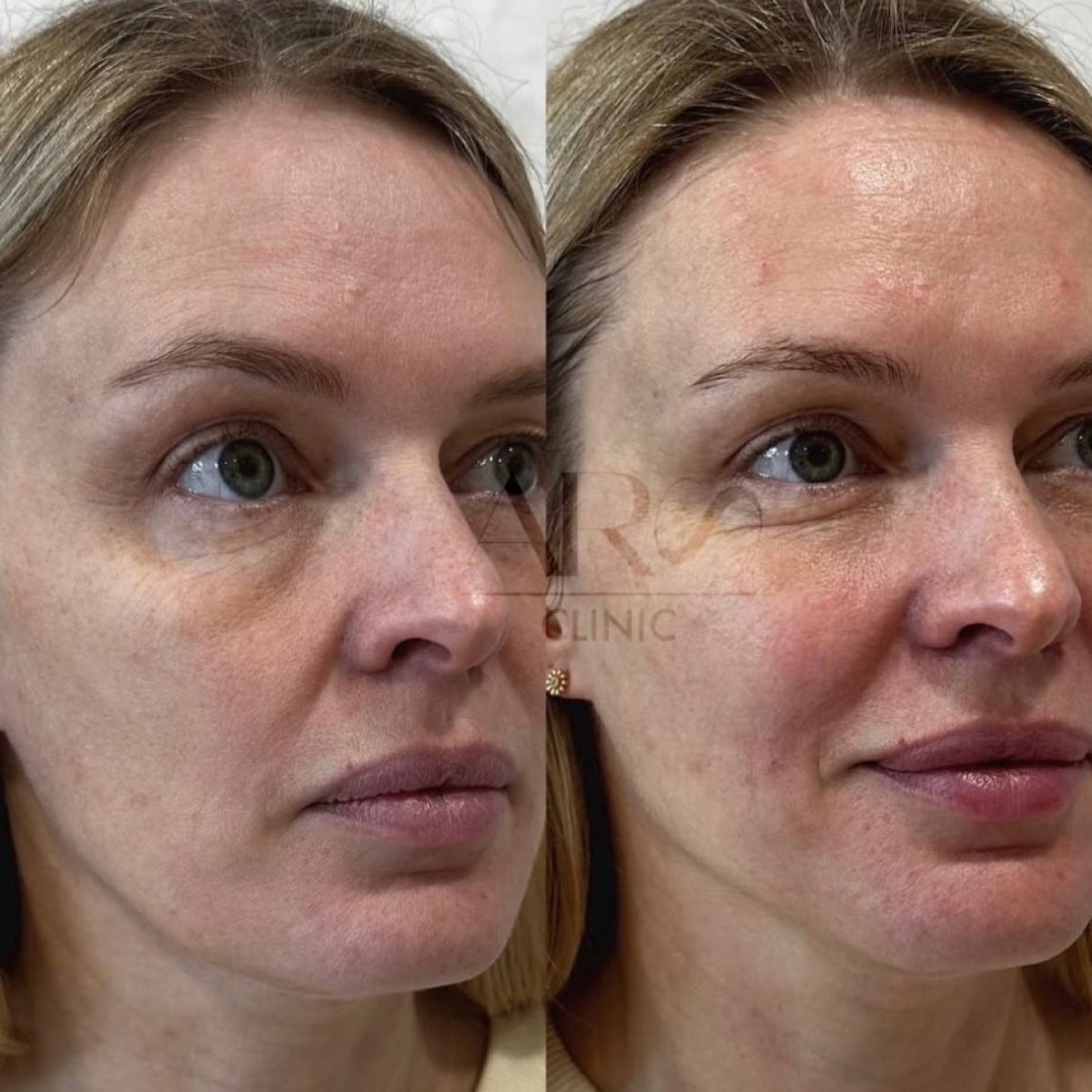 Before and after nonsurgical facelift results at ARS Clinic – visible facial rejuvenation