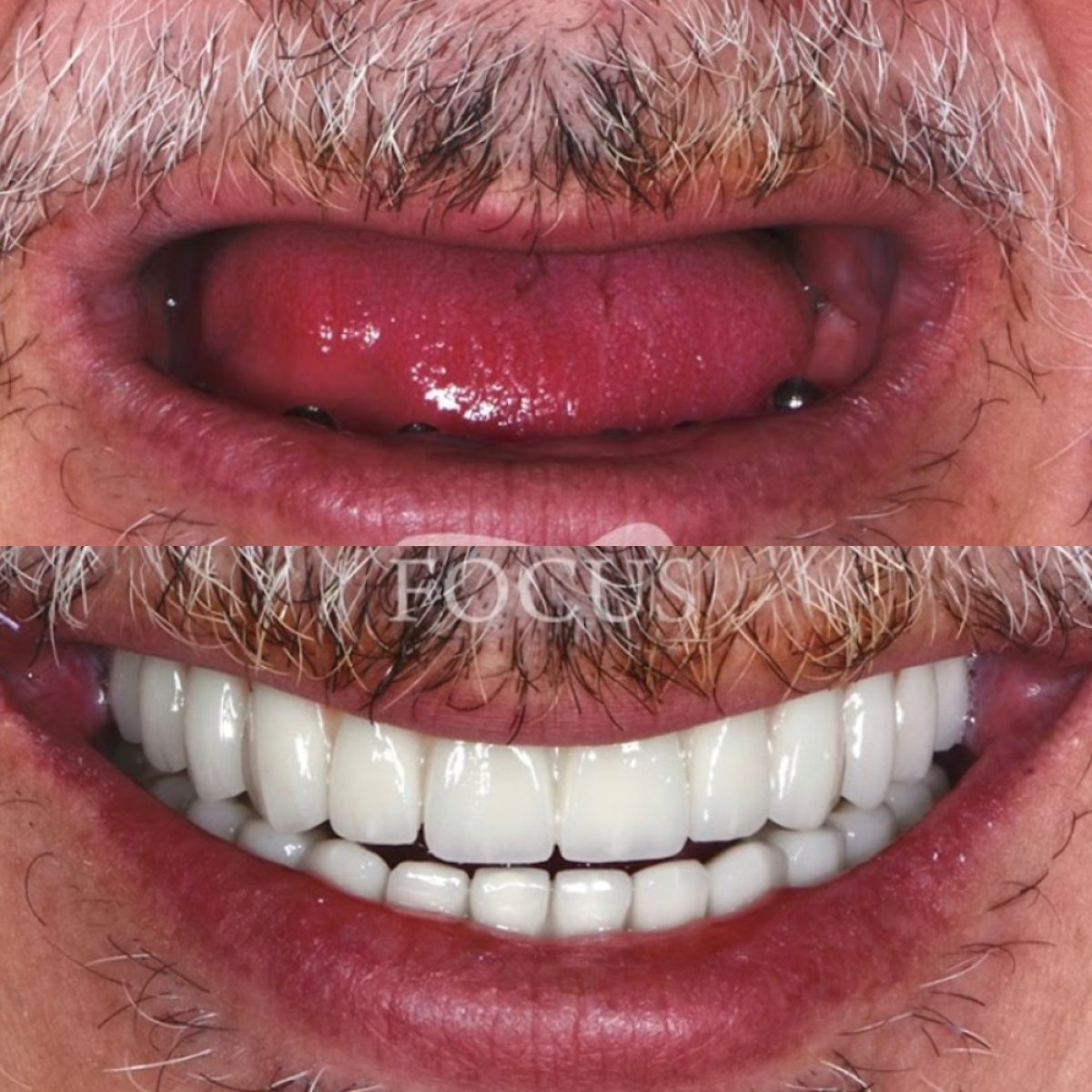نتيجة قبل وبعد زراعة الأسنان All-on-4 في Focus Dental Clinic - Bodrum، استعادة الابتسامة