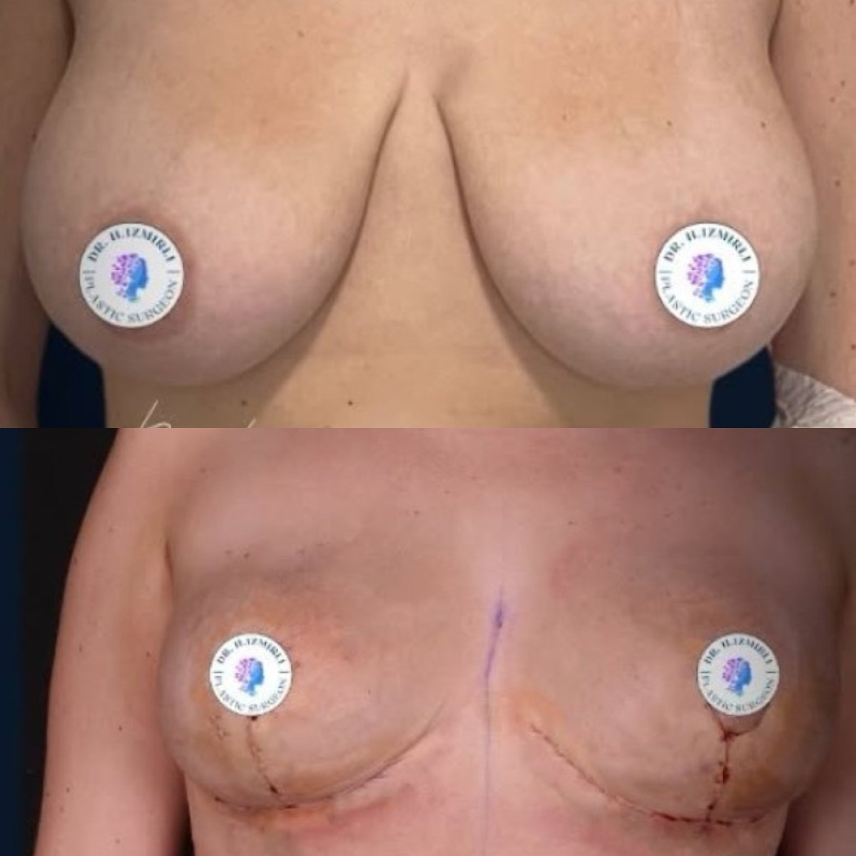 Before and after breast reduction results at Dr. Hakki Izmirli's Private Clinic, improved contour
