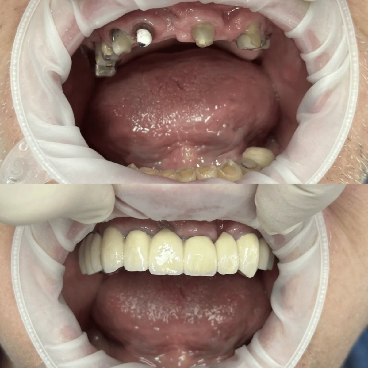 Before and after dental prosthetics installation results at Completdent Clinic, improved smile