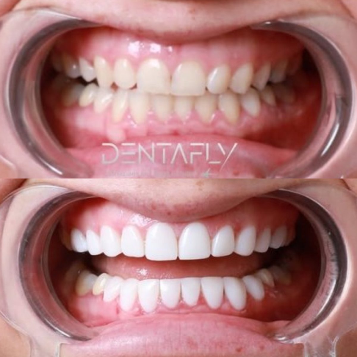 Before and after dental bonding results at DENTAFLY DENTAL IMPLANT & SMILE STUDIO, smile improvement