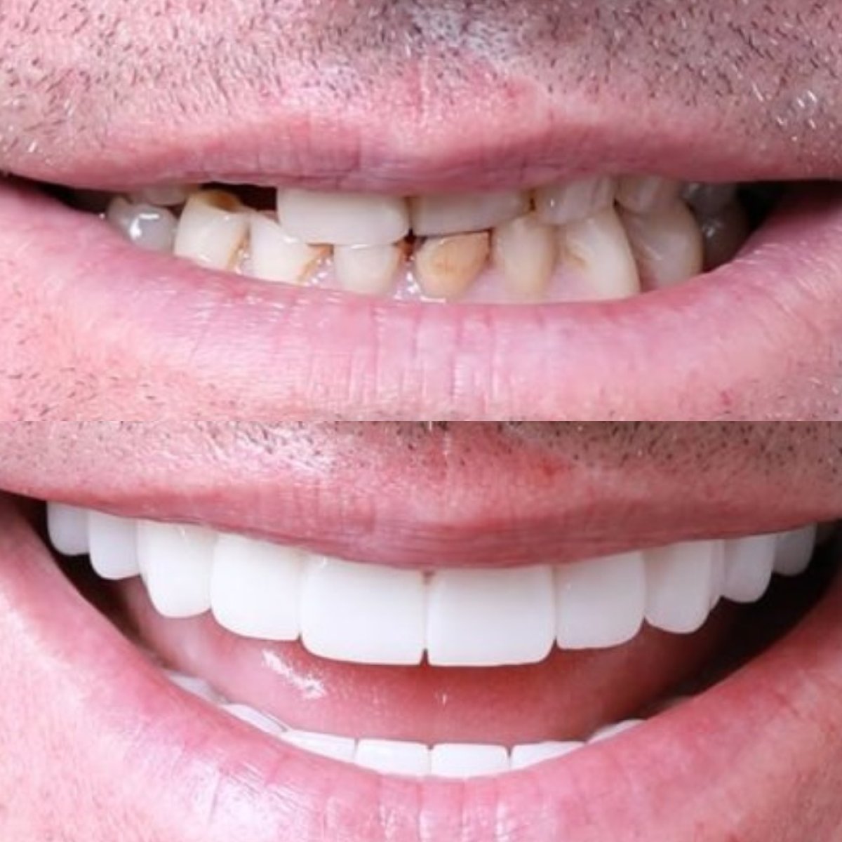 Before and after Hollywood Smile results at DENTAFLY DENTAL IMPLANT & SMILE STUDIO, whiter teeth