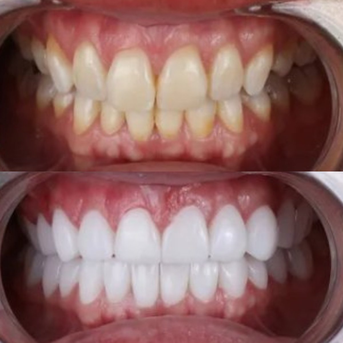 Before and after veneers result at DENTAFLY DENTAL IMPLANT & SMILE STUDIO, smile transformation