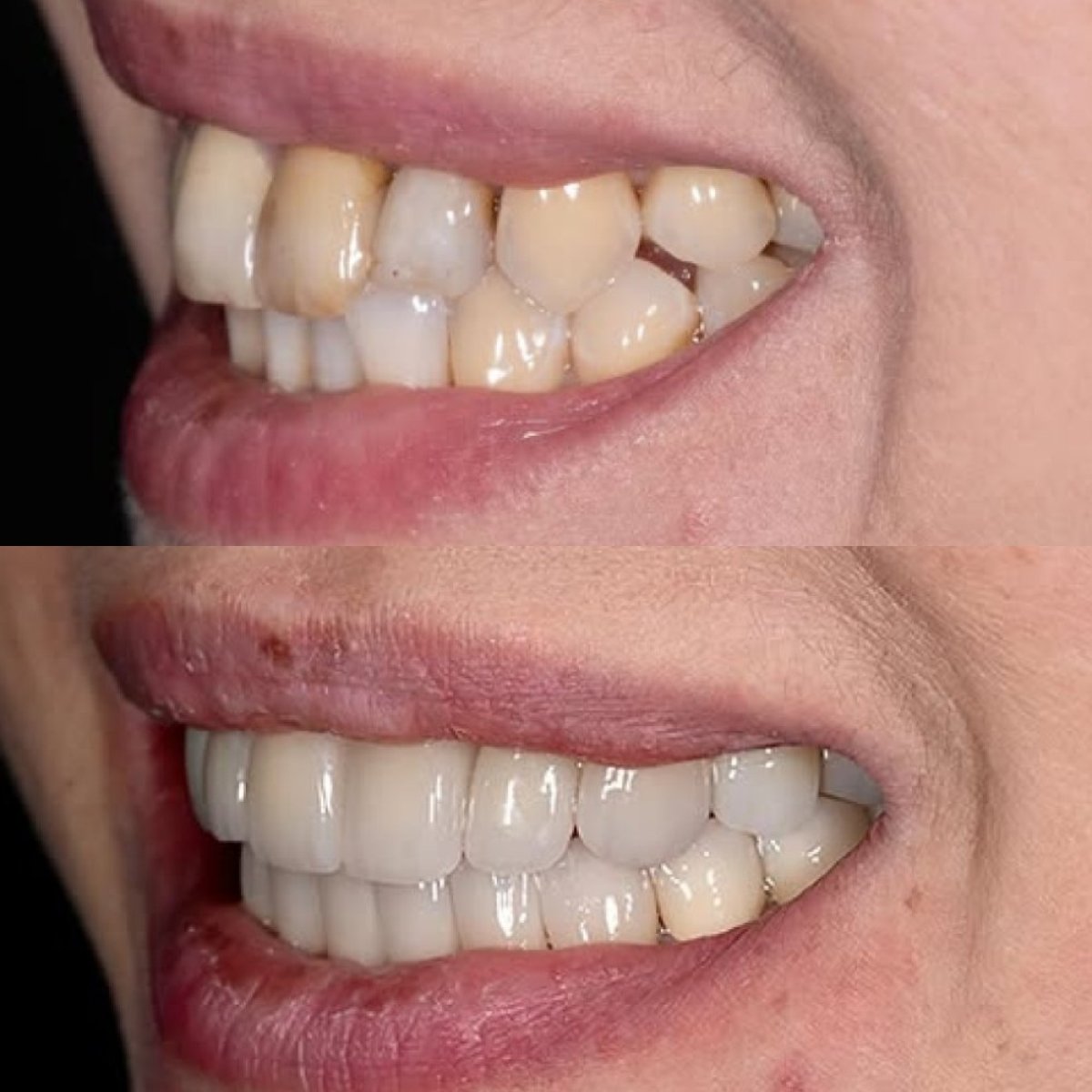 Результат до та після встановлення вініров у DENTAFLY DENTAL IMPLANT & SMILE STUDIO, зміна посмішки