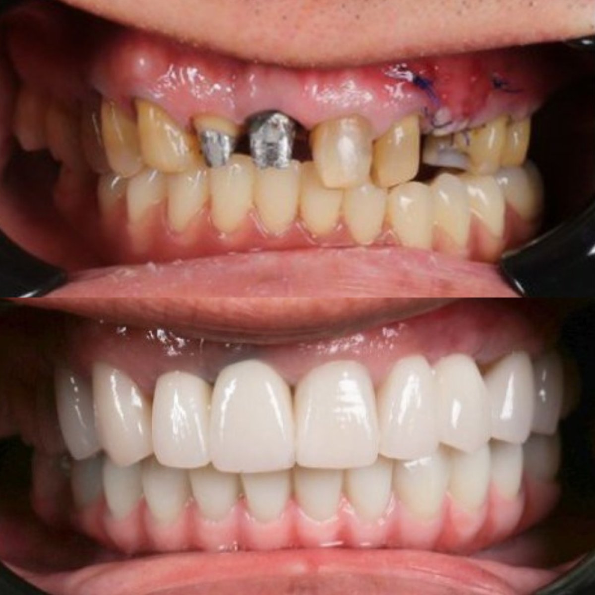 Результати до і після встановлення зубних коронок у Dr. Care Implant Clinic, покращена посмішка