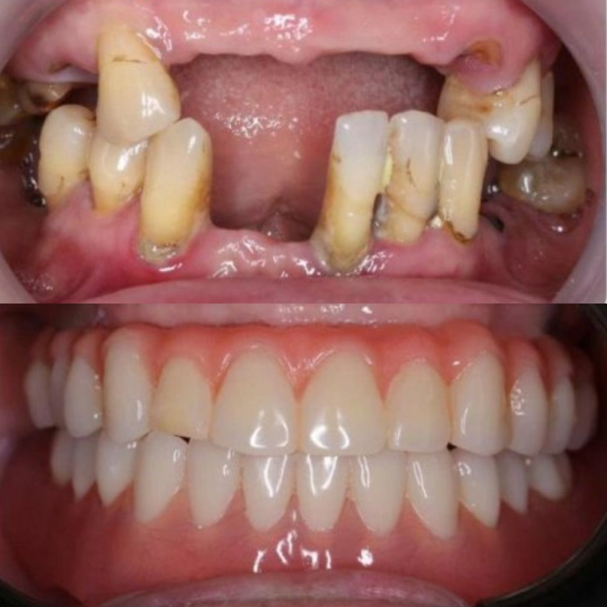 Результати до і після імплантації зубів з коронкою в Dr. Care Implant Clinic, відновлення посмішки