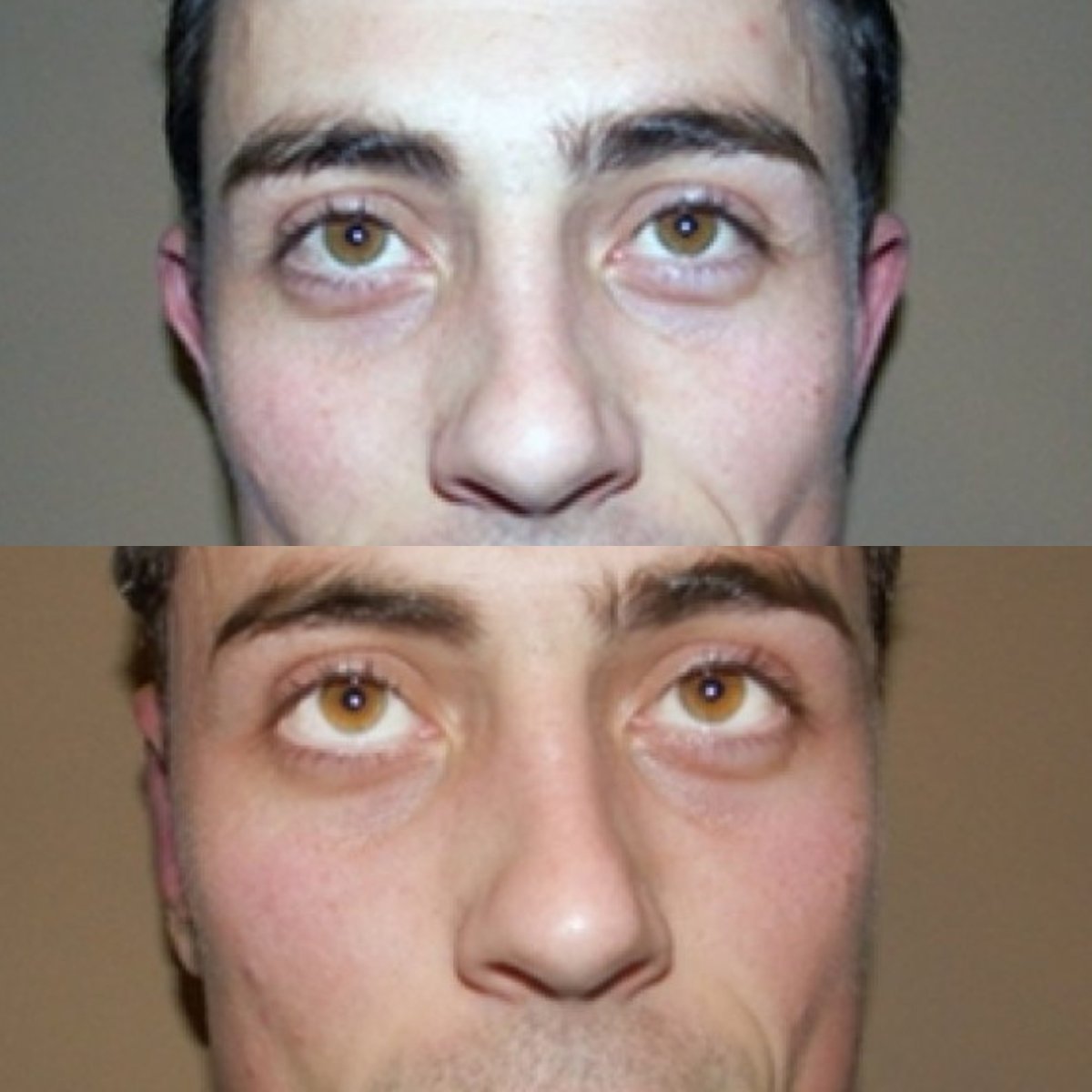 نتائج عملية تجميل الأذن قبل وبعد في FORME Clinic، تحسين شكل الأذن وتناسقها