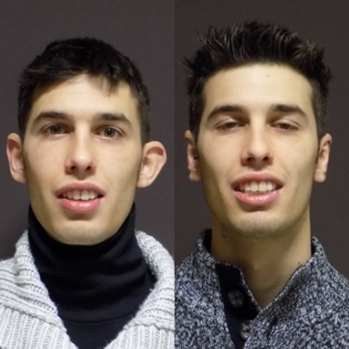 Before and after otoplasty results at FORME Clinic – improved ear shape and symmetry
