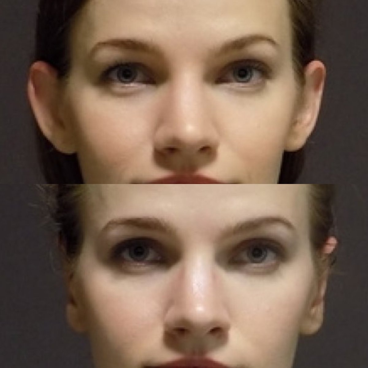 Before and after otoplasty results at FORME Clinic, ear reshaping with natural appearance