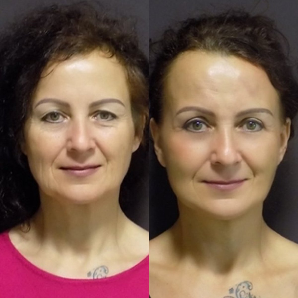Before and after facelift results at FORME Clinic – visible facial rejuvenation and smoother skin
