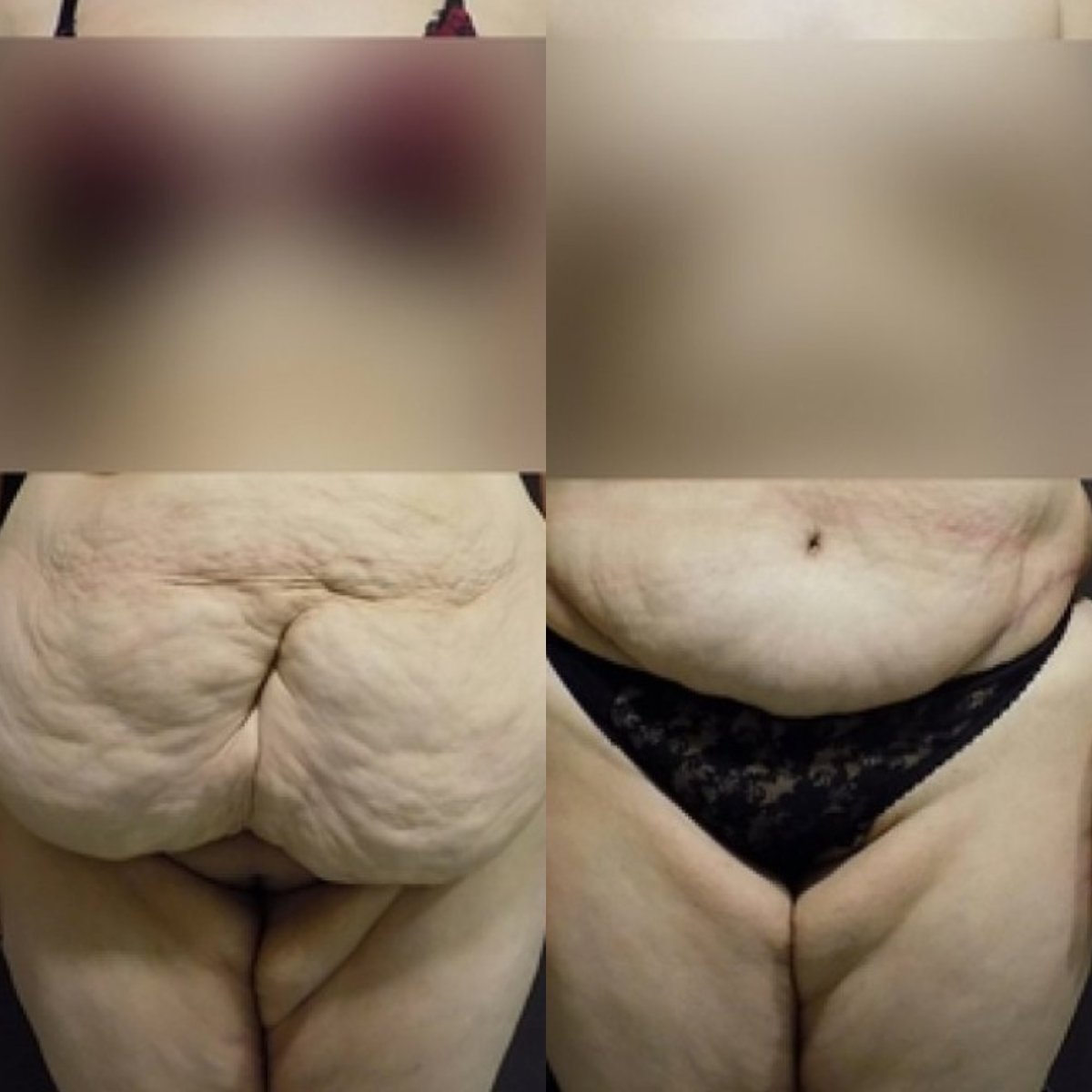 نتائج شد البطن قبل وبعد في FORME Clinic، تحسين شكل البطن والجلد