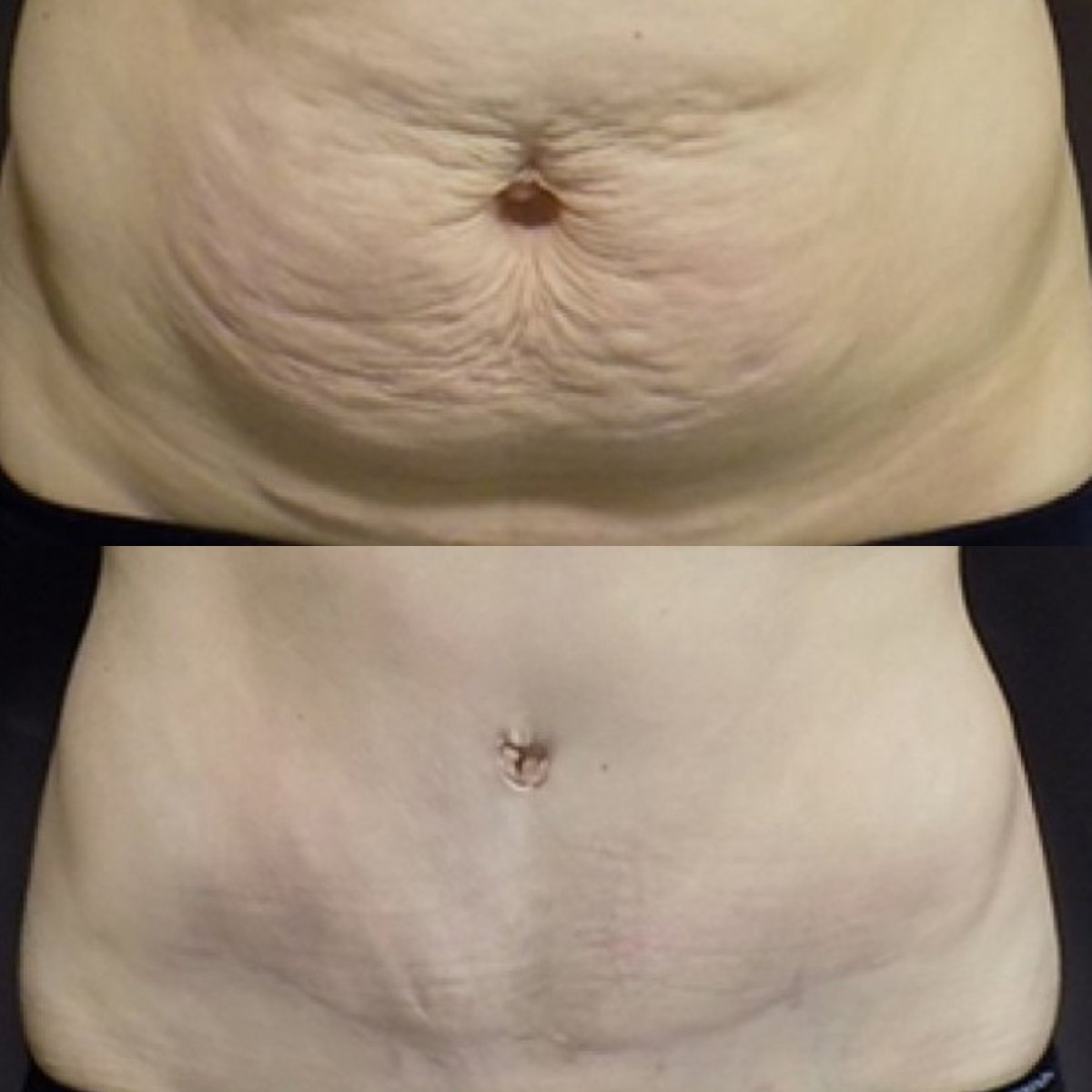 Résultats avant et après abdominoplastie à FORME Clinic – contour abdominal amélioré