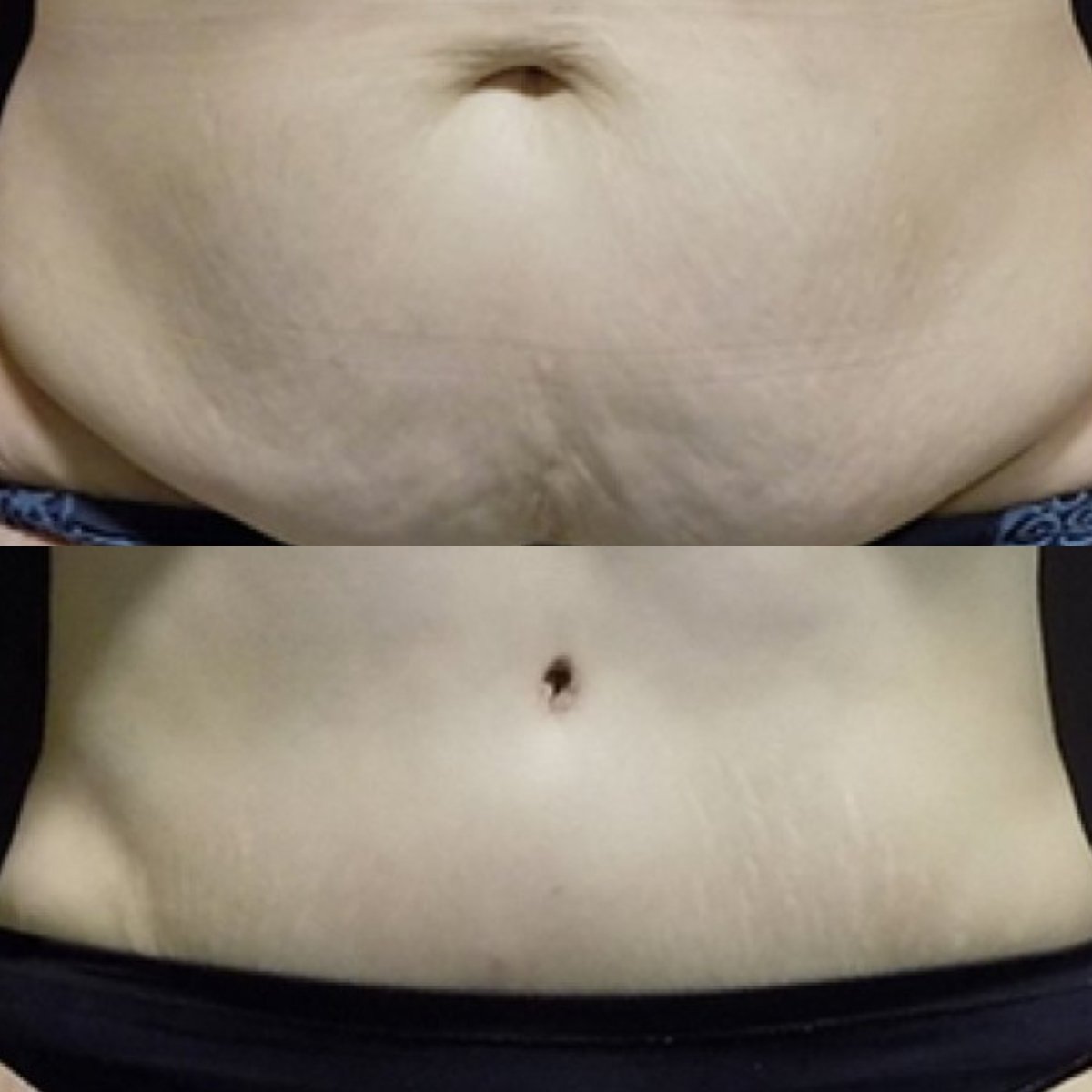 Résultats avant/après abdominoplastie à FORME Clinic – ventre plus plat