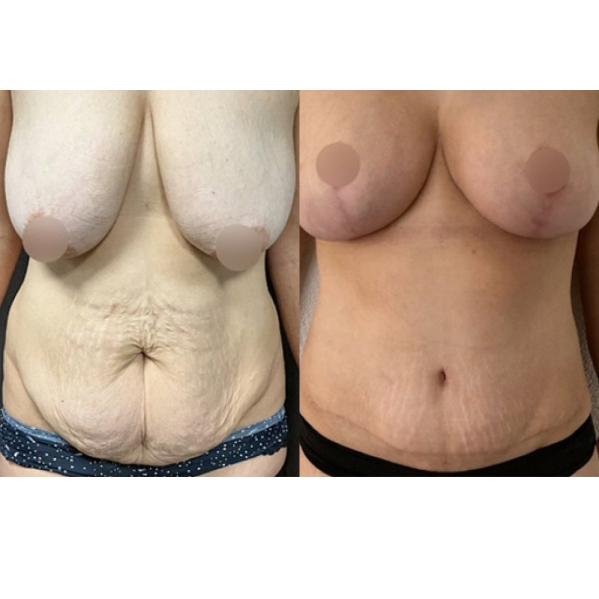 Before and after mommy makeover results at FORME Clinic – breast and abdomen contouring