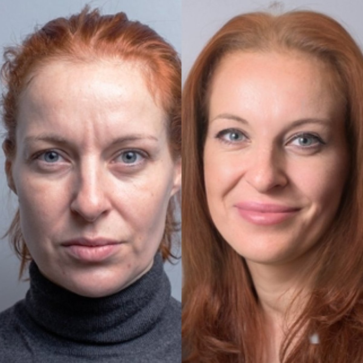 Before and after Botox wrinkle treatment results at FORME Clinic, smoother youthful skin