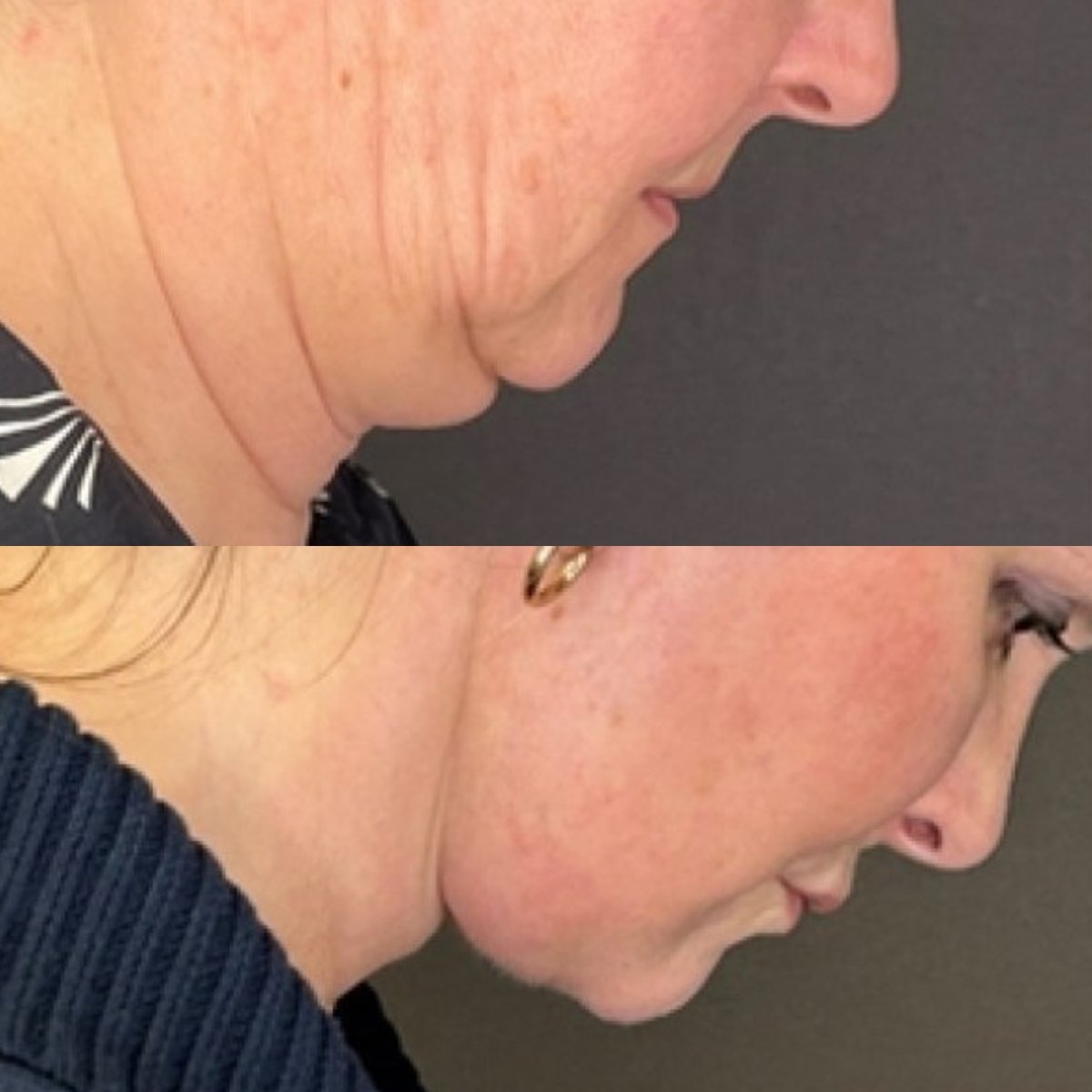 Before and after neck lift results at FORME Clinic – improved jawline and reduced sagging