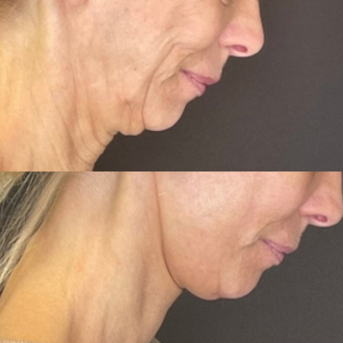 Before and after neck lift results at FORME Clinic – improved neck contour and skin tightening