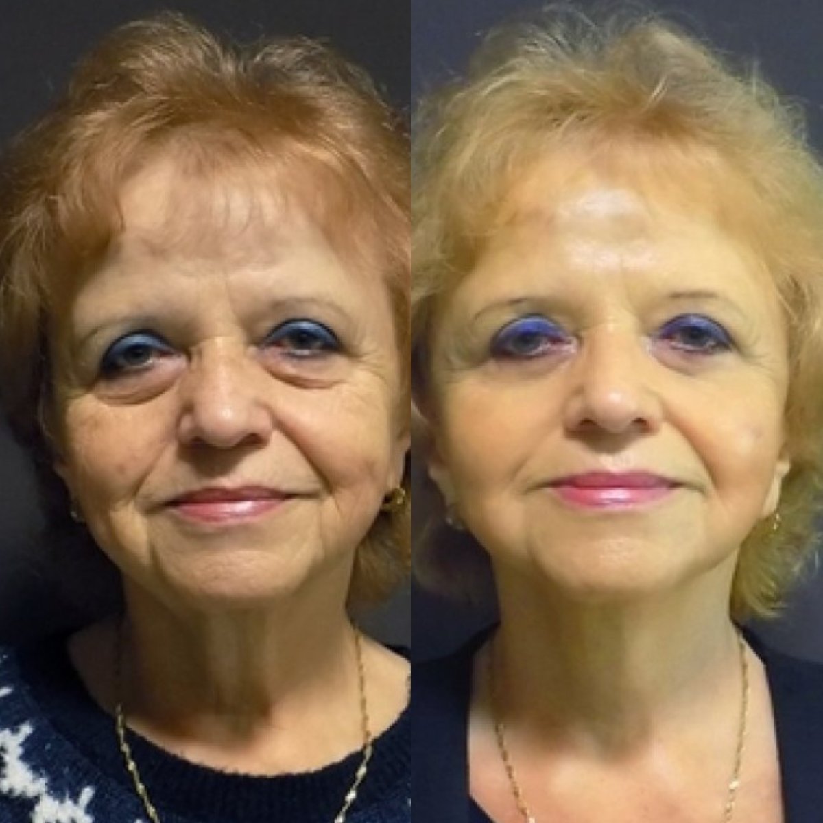Resultados de lifting de cuello antes y después en FORME Clinic, piel más firme y rejuvenecida