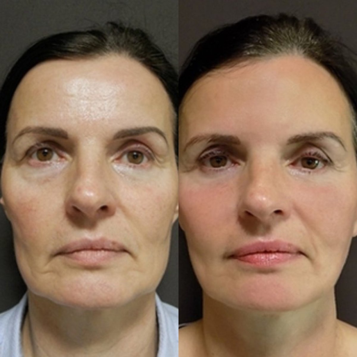Before and after Deep Plane Facelift results at FORME Clinic – facial rejuvenation visible
