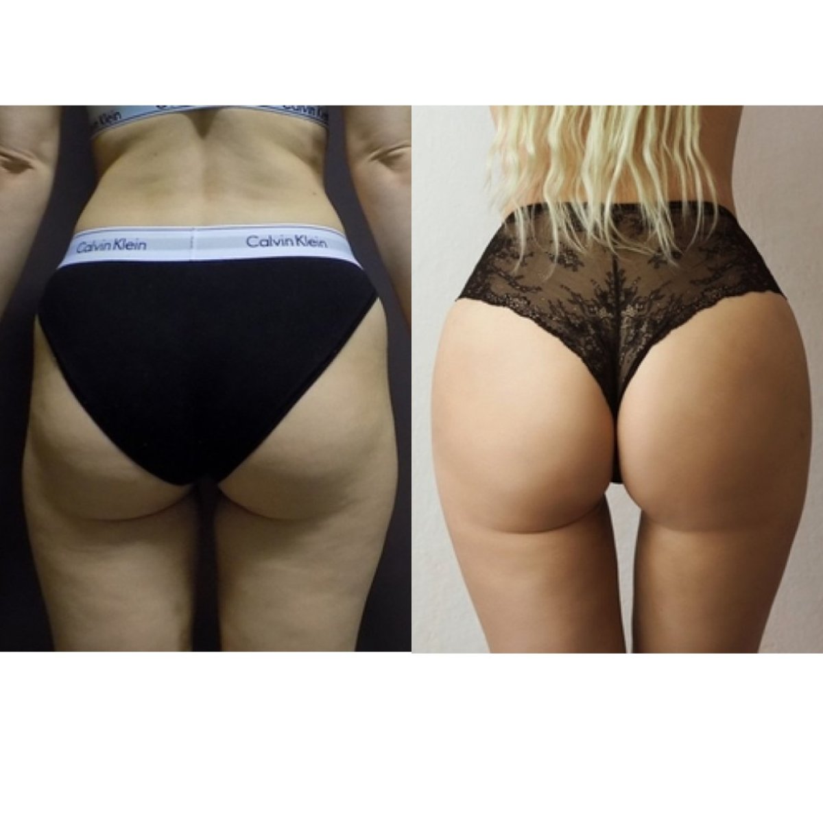 Before and after Brazilian Butt Lift results at FORME Clinic – enhanced buttock contour