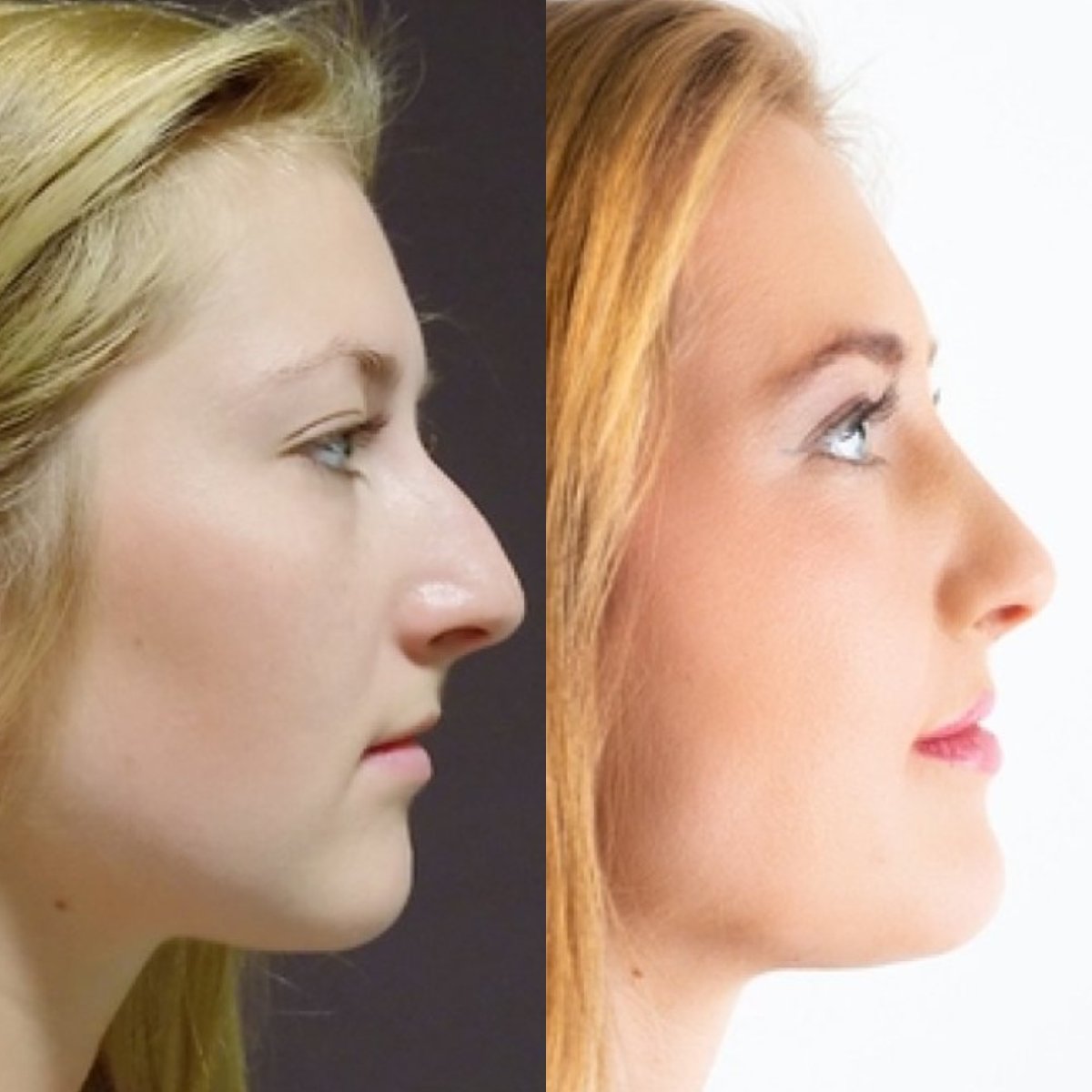 Before and after rhinoplasty results at FORME Clinic, nose reshaping with natural profile