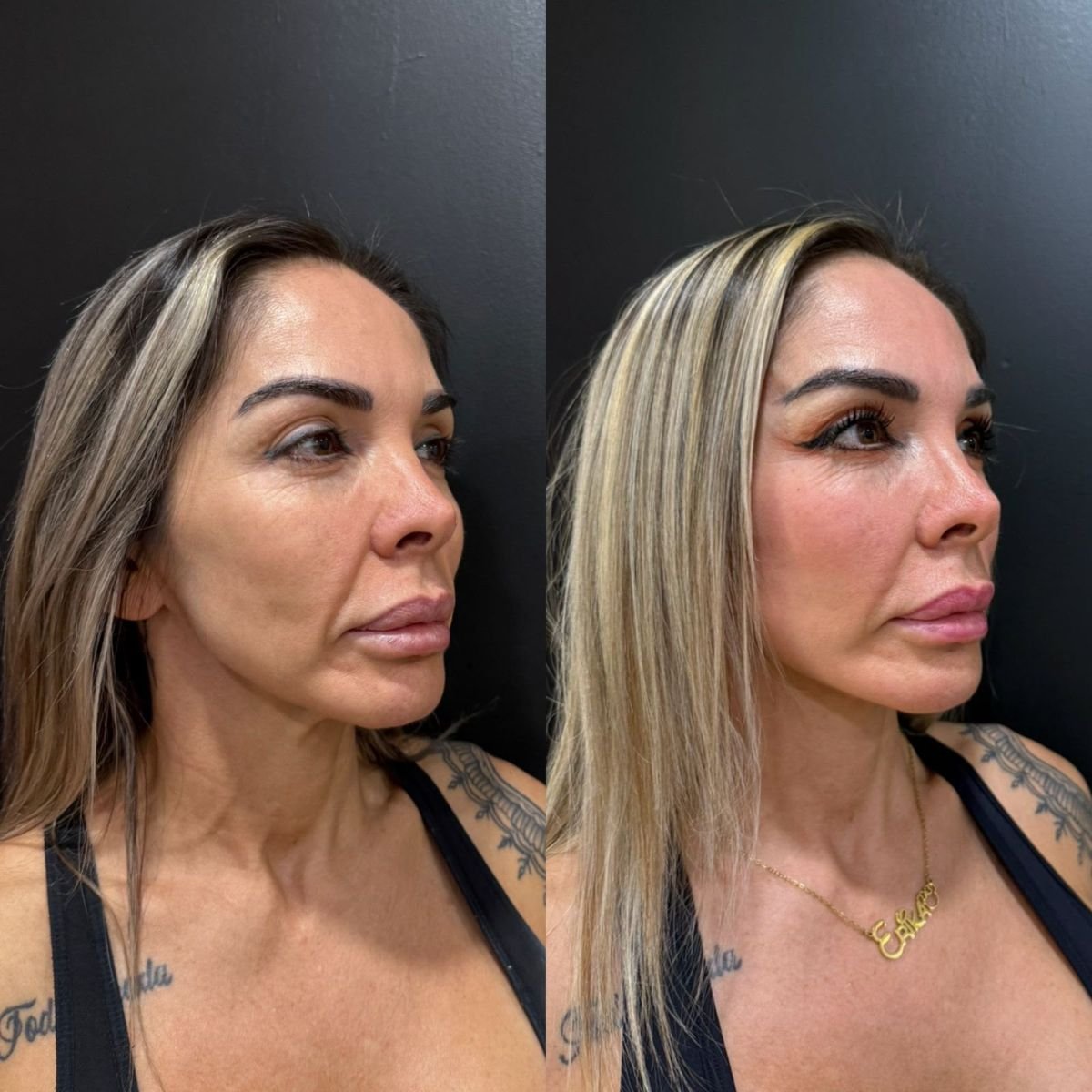 نتائج شد الوجه قبل وبعد في Dr. Alexandro Aguilera - Plastic Surgery، تجديد شباب الوجه