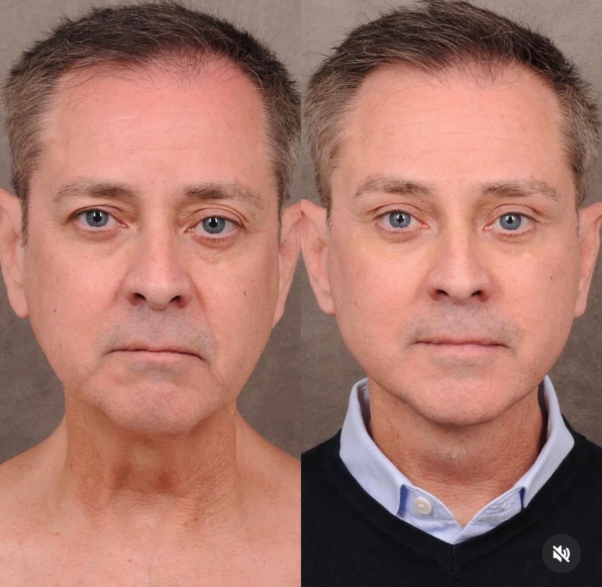 Efekty przed i po liftingu twarzy w Dr. Alexandro Aguilera - Plastic Surgery, odmłodzenie